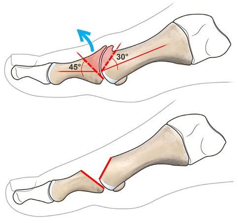 Diagram of Valenti resection arthroplasty preserving the plantar portion of the proximal phalanx