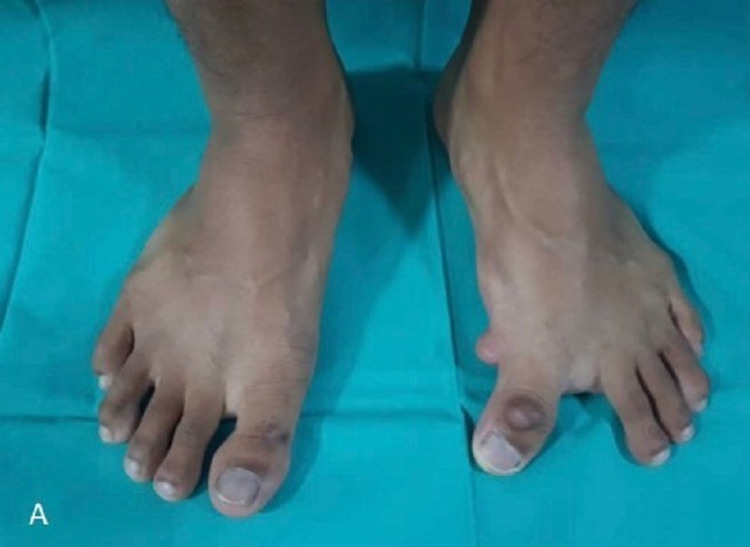 Congenital hallux varus — the great toe deviates medially (away from the second toe), the opposite of a bunion.