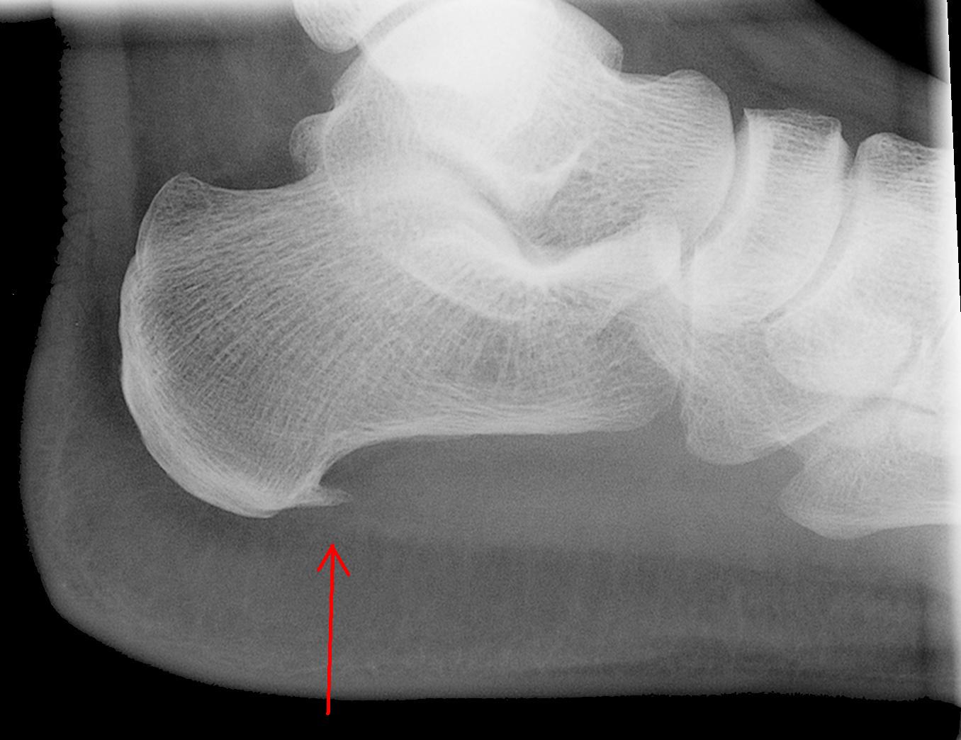 Lateral X-ray showing a plantar calcaneal (heel) spur. Despite their dramatic appearance on imaging, the spur itself is rarely the source of pain — surrounding soft tissue (most commonly the plantar fascia) is.