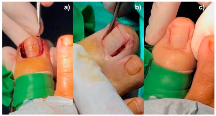 Three-panel surgical illustration showing the steps of surgical matrix removal for an ingrown toenail: (a) wedge excision of the offending nail edge and adjacent tissue, (b) curettage of the underlying nail matrix and nail bed, (c) reapproximation of the surrounding skin folds