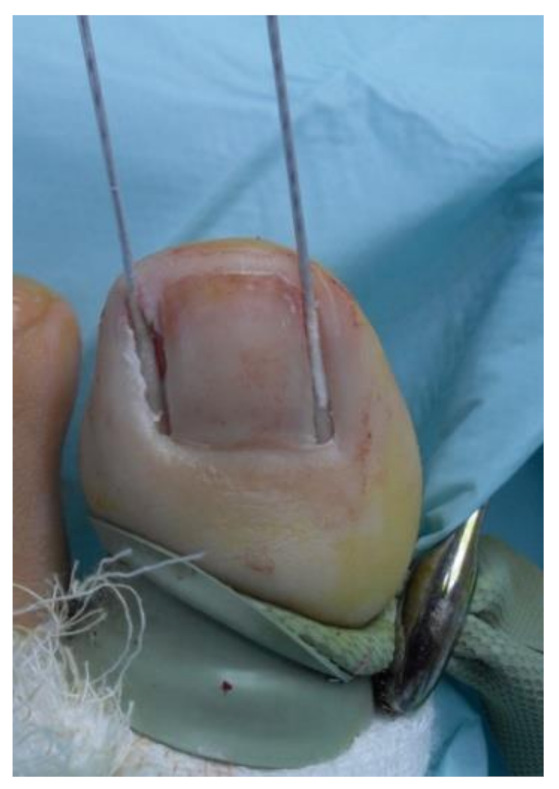 Clinical photograph showing a cotton swab soaked in 88% phenol being applied to the exposed nail matrix and nail bed after partial nail avulsion — the chemical alternative to surgical curettage