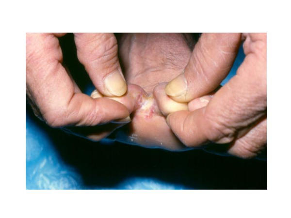 Interdigital tinea pedis — peeling and maceration of skin between the toes