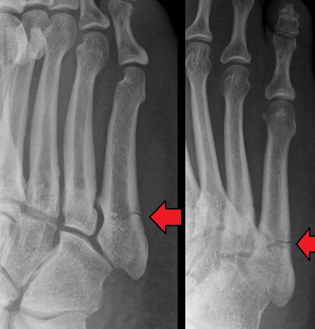 Lateral X-ray showing a true Jones fracture (Zone 2) at the metaphyseal-diaphyseal junction of the fifth metatarsal