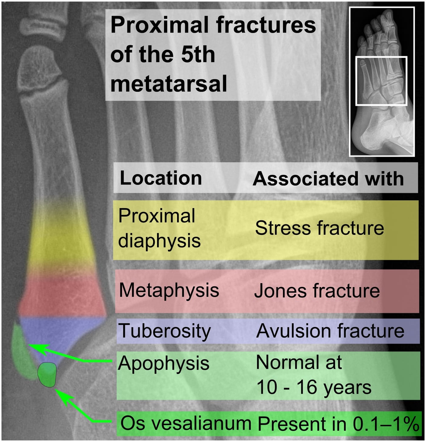 The three zones of proximal fifth metatarsal fractures — Zone 1 (avulsion at the tuberosity), Zone 2 (true Jones fracture at the metaphyseal-diaphyseal junction with poor blood supply), and Zone 3 (proximal diaphyseal stress fracture). The zone determines whether the fracture is likely to heal with a boot or whether surgery is required.
