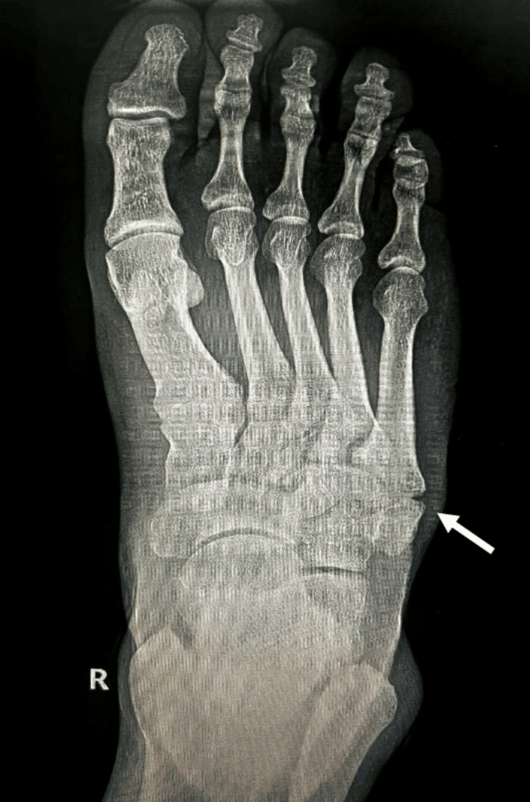 X-ray showing a Zone 1 avulsion fracture at the base of the fifth metatarsal