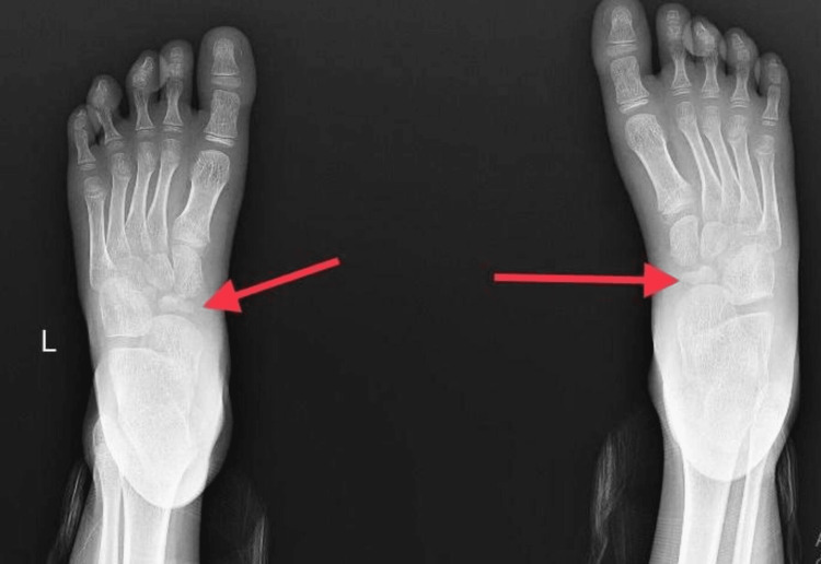 Köhler's disease — AP X-ray showing irregular, sclerotic, and shrunken navicular bones bilaterally (an unusual bilateral case in a six-year-old boy).