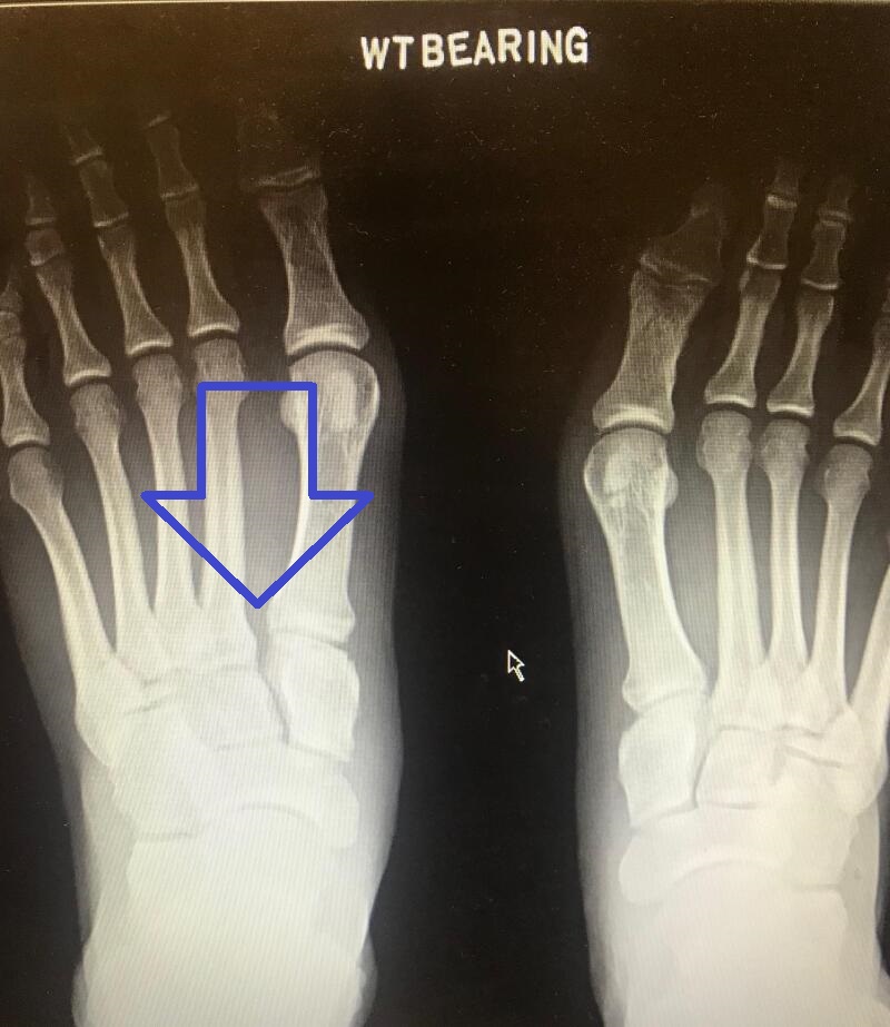 Lisfranc injury — bilateral weight-bearing X-rays showing subtle diastasis (widening) between the medial and middle cuneiform of the left foot from a Lisfranc ligament rupture. The right foot is normal for comparison.