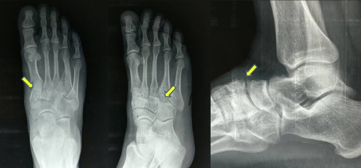 Tarsometatarsal arthritis — pre-operative X-ray showing arthritic changes at the 1st, 2nd, and 4th TMT joints in a patient with a 2-year-old neglected Lisfranc injury.