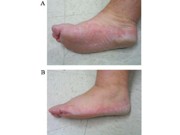 Moccasin-type tinea pedis — chronic dry, scaly, thickened skin covering the sole and sides of the foot