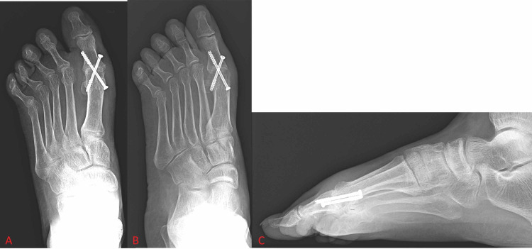 Post-operative X-ray showing crossed-screw fixation of a first MTP joint fusion