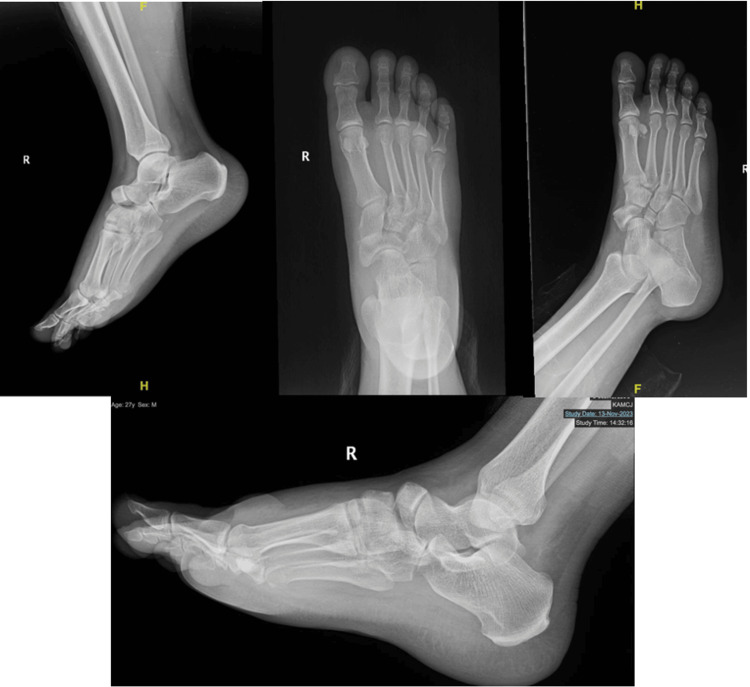 Pre-operative X-ray showing navicular fracture and midfoot dislocation after a fall.