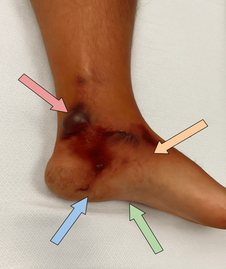 Clinical photograph of the lower leg and foot showing skin discoloration, ecchymosis, and a hemorrhagic bulla over the ankle — hallmark findings of necrotizing fasciitis
