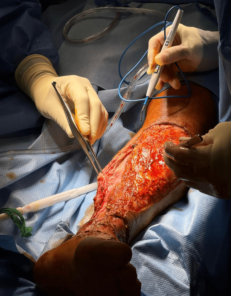 Intraoperative photograph showing extensive surgical debridement of the lower extremity, with non-viable skin and fascia excised to expose underlying healthy muscle