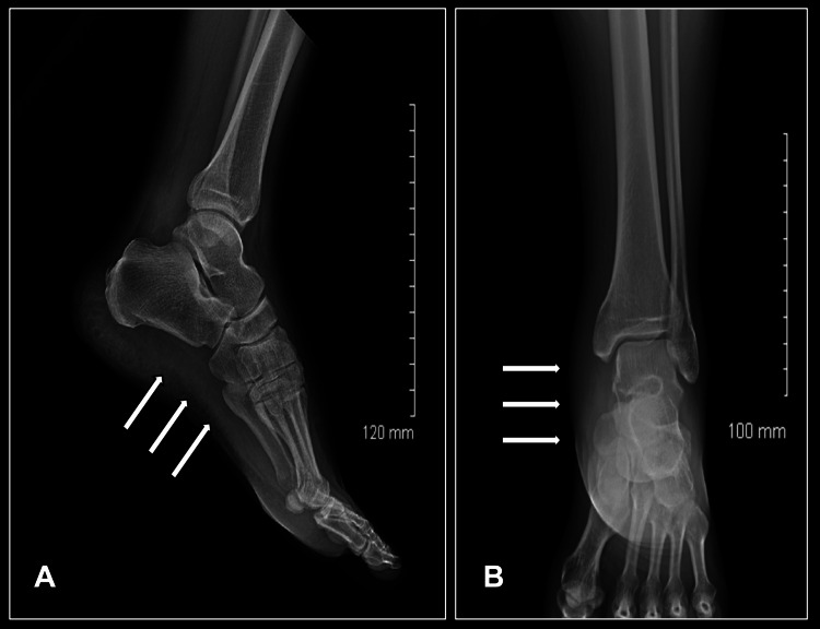 Plain radiograph of the lower leg showing soft-tissue gas tracking along fascial planes — a key radiologic sign of necrotizing fasciitis