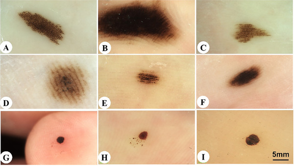 Multi-panel dermoscopic photograph showing the typical patterns of acral (plantar and palmar) melanocytic nevi: (A) parallel furrow pattern with linear pigmentation along the skin furrows, (B) fibrillar pattern with fine parallel fibers running perpendicular or oblique to furrows, (C) lattice-like reticular pattern with pigmented bands connecting adjacent ridges, (D) mixed pattern (pea pod appearance), (E) globular pattern with pigment spheres of varying sizes, (F) homogeneous pattern with uniform tan or brown regions, and (G-I) black heel (talon noir) features shown for comparison
