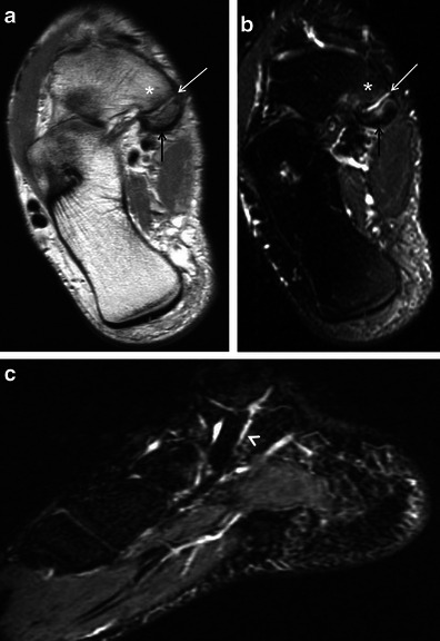 Imaging of an accessory navicular ossicle showing the bony anatomy and relationship to the main navicular bone