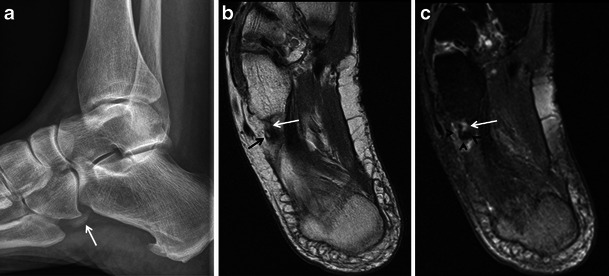 Three-panel imaging of os peroneum: lateral X-ray showing a small ossicle within the peroneus longus tendon along the lateral foot, axial MRI views showing the os peroneum and surrounding tendon