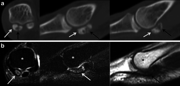 Six-panel imaging showing osteonecrosis of a sesamoid: top row CT views showing fragmentation and sclerosis of the sesamoid bone, bottom row MRI views showing the corresponding signal abnormalities
