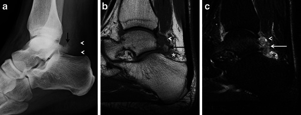 Three-panel imaging of os trigonum: lateral X-ray of the ankle showing a small accessory bone behind the talus (arrowheads), MRI showing the os trigonum at the same location, and fat-saturated MRI showing surrounding edema indicative of os trigonum syndrome (posterior ankle impingement)