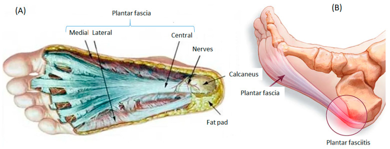 Anatomy of the plantar fascia. Left (A): frontal-plane view showing the medial, central, and lateral bands. Right (B): the posterior insertion at the calcaneus, the most common site of pain in plantar fasciitis.