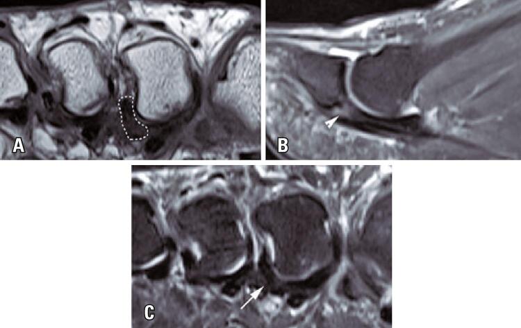 MRI showing degenerative attenuation and partial tearing of the plantar plate at the second MTP joint
