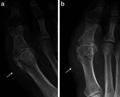 Two-panel X-ray of sesamoid osteomyelitis showing bone destruction and irregular outline of the sesamoid bone with surrounding soft tissue swelling