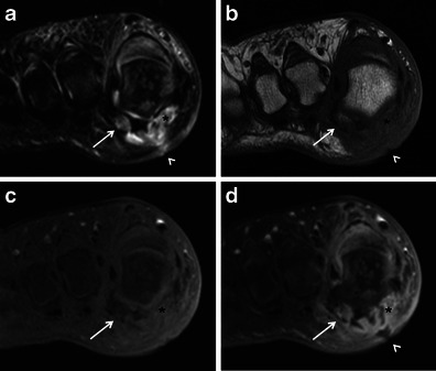 Four-panel MRI of sesamoid osteomyelitis showing bone marrow signal abnormalities, surrounding soft tissue inflammation, and tissue destruction consistent with bone infection