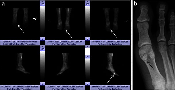 Sesamoiditis on imaging. Top: bone scan of both feet showing intense tracer uptake localized to the medial hallucal sesamoid — a sign of active bone inflammation. Bottom: AP X-ray of the same patient showing a bipartite medial sesamoid with no fragmentation or sclerosis. The combination — symptomatic sesamoid + bone scan uptake + structurally normal X-ray — supports a diagnosis of bony sesamoiditis rather than fracture.