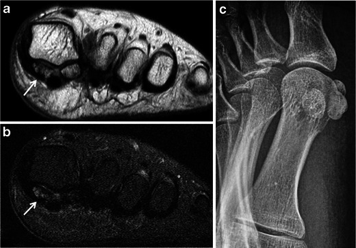 Three-panel imaging of sesamoiditis: axial MRI views showing edema and signal change at the symptomatic sesamoid (arrows), and a lateral X-ray showing the sesamoid in profile