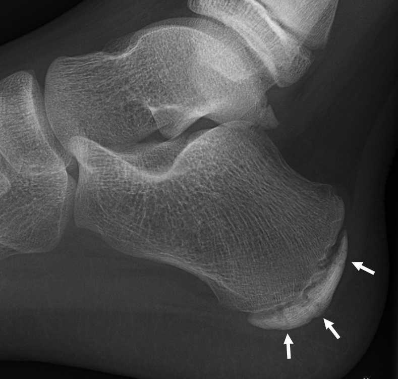 Lateral foot X-ray of an 11-year-old showing sclerosis and fragmentation of the calcaneal apophysis — features sometimes seen with Sever's disease, but with low sensitivity and specificity. The diagnosis is mainly clinical.