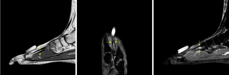 MRI of the foot showing bright bone marrow edema in the second metatarsal consistent with a stress fracture
