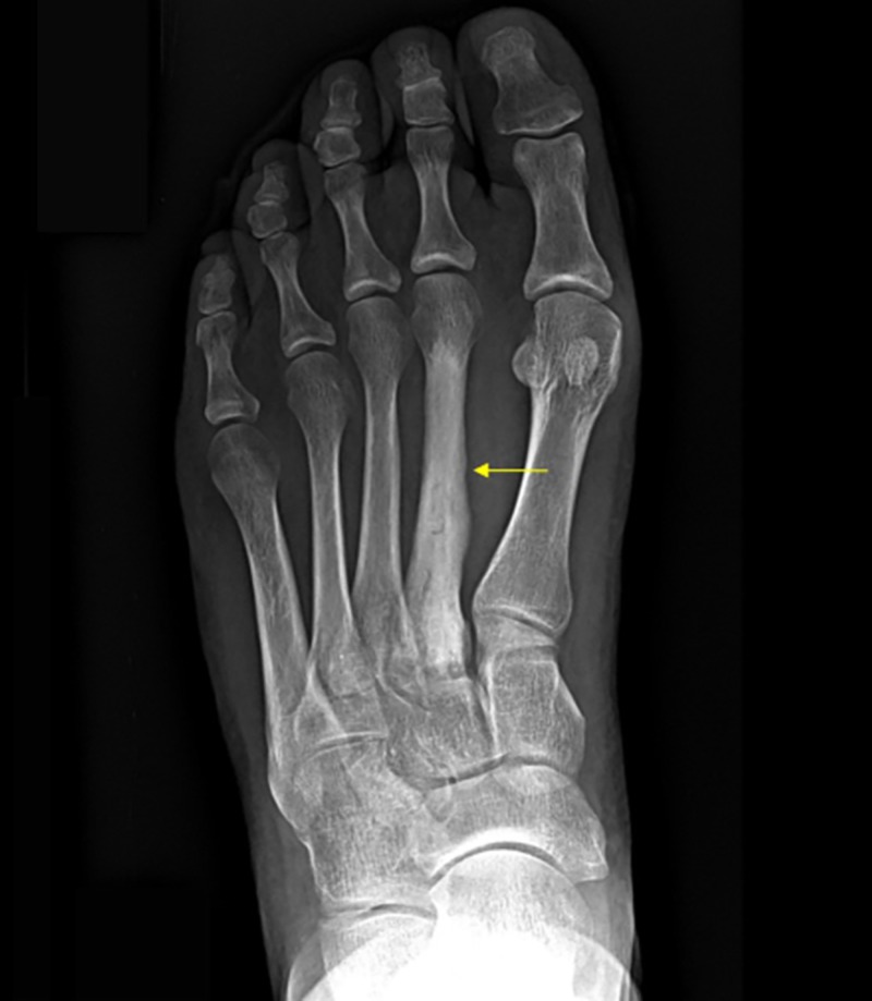 Second metatarsal stress fracture — X-ray showing diffuse sclerotic changes characteristic of a chronic stress injury. Plain X-rays are often normal in the first 2–3 weeks of symptoms; MRI is more sensitive for early diagnosis.
