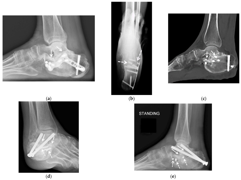 Lateral weight-bearing radiograph and sagittal CT showing marked narrowing of the subtalar joint consistent with advanced posttraumatic osteoarthritis