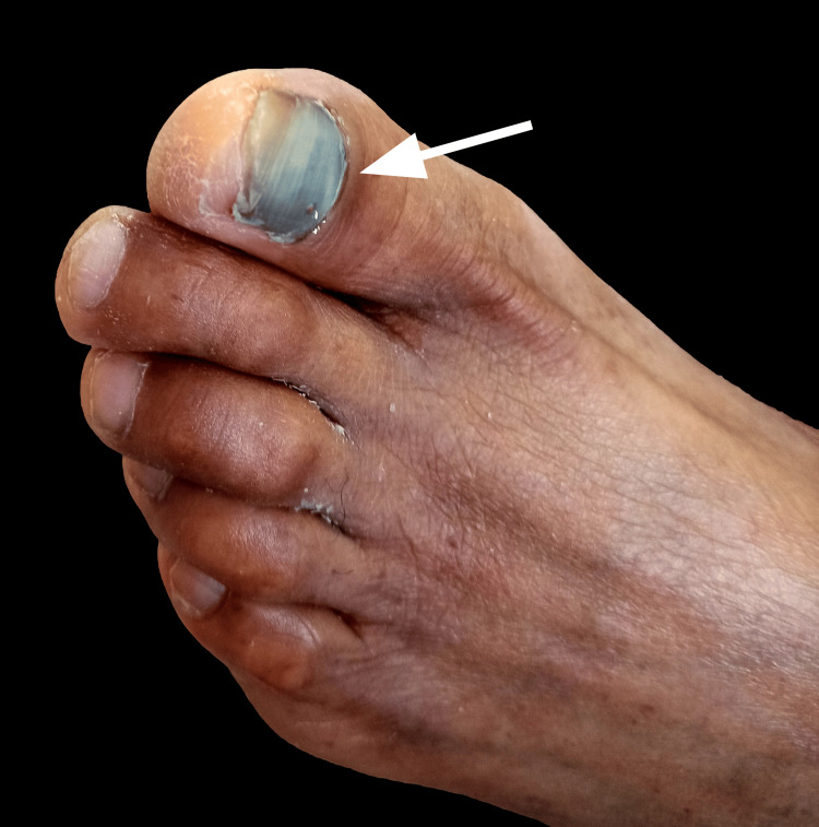 Subungual hematoma of the great toenail showing dark red and purple discoloration under the nail plate from trapped blood after trauma