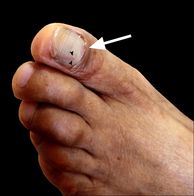 Toenail after subungual hematoma drainage showing the small drainage hole and partial decompression of the trapped blood