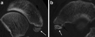 Two-panel CT scan showing a Type 2 accessory navicular with synchondrosis (cartilage joint) between the accessory bone and the main navicular — irregular interface and surrounding bone changes are visible