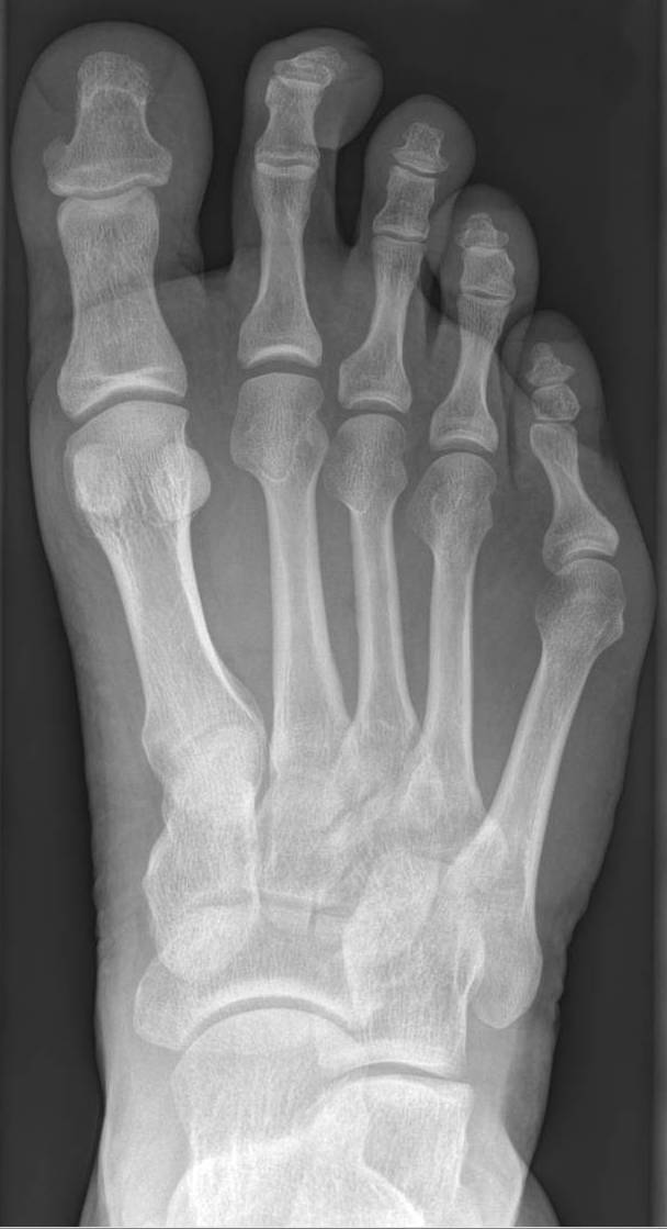 AP X-ray showing tailor's bunion (bunionette) with widened 4th intermetatarsal angle