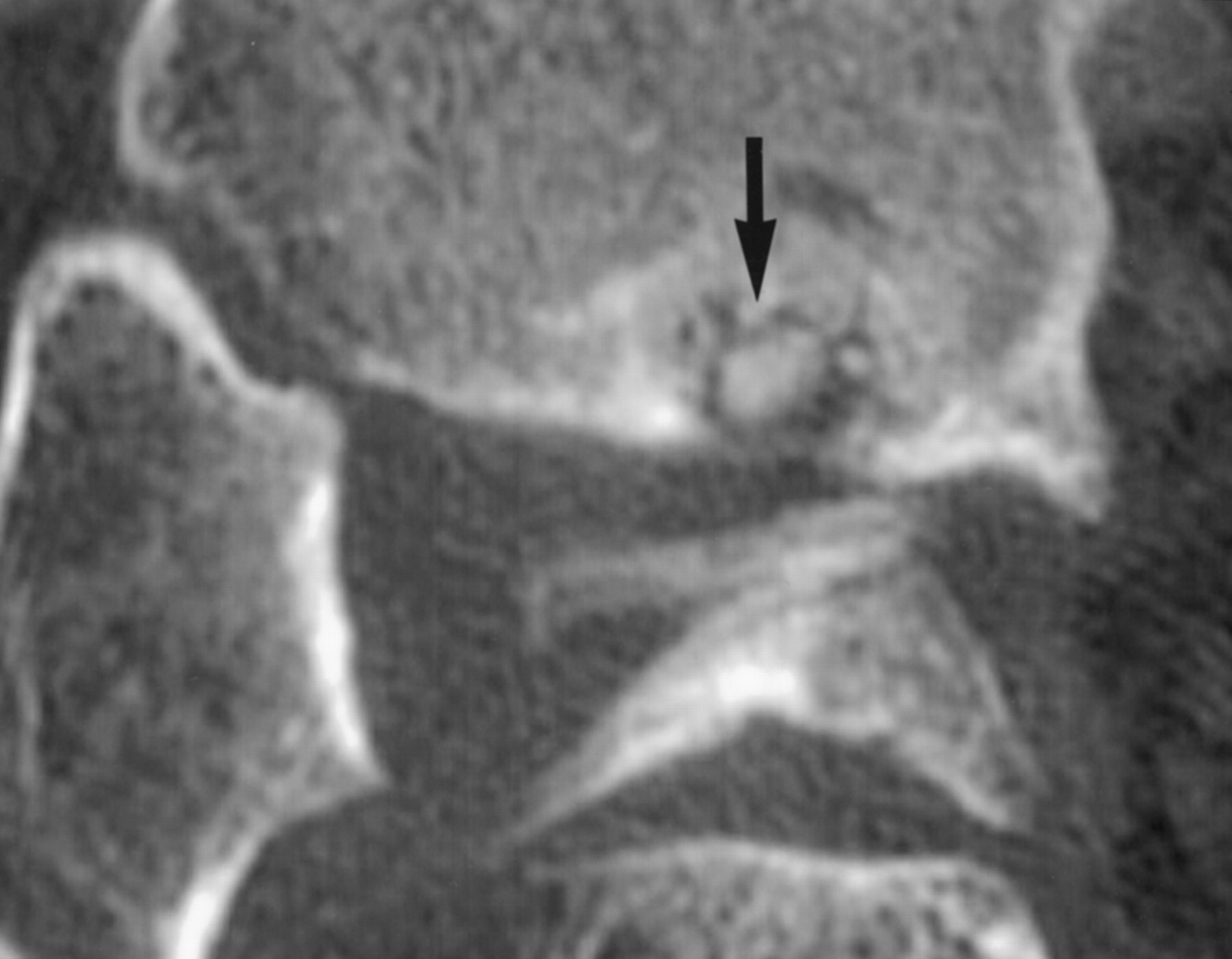 Coronal CT of the ankle showing an osteochondral lesion with a loose body in the medial aspect of the tibial plafond.