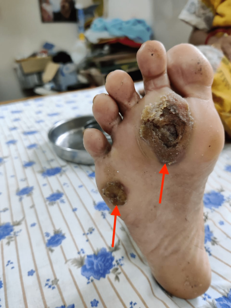 Clinical photograph of talon noir showing two irregular, blackish-brown plaques on the plantar aspect of the right foot — caused by trauma-induced bleeding into the thick skin of the heel