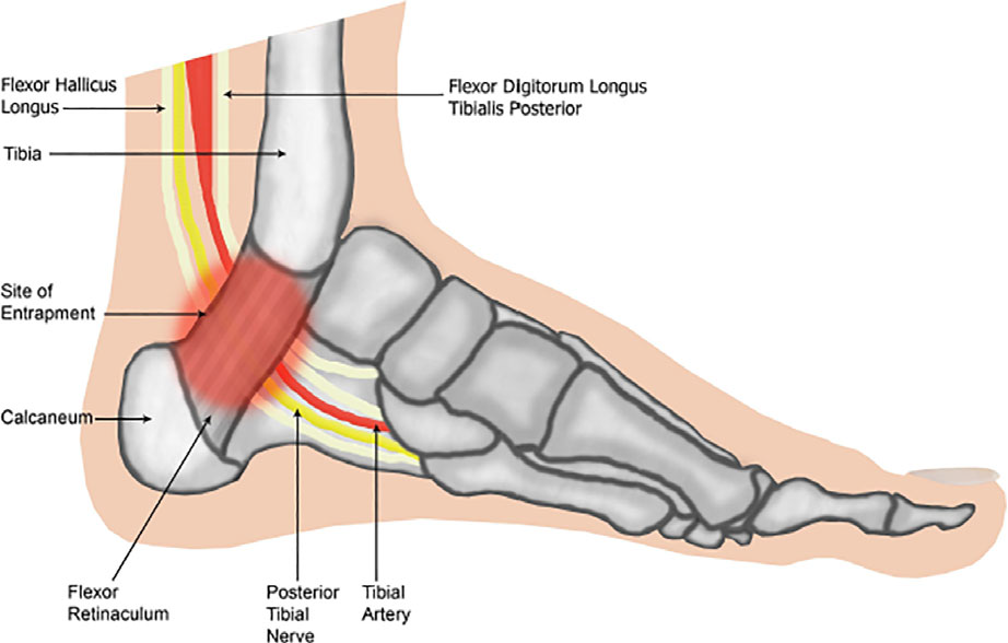 Anatomy of the tarsal tunnel — the tibial nerve, posterior tibial artery, and tendons of the tibialis posterior, flexor digitorum longus, and flexor hallucis longus all pass behind the medial malleolus deep to the flexor retinaculum.