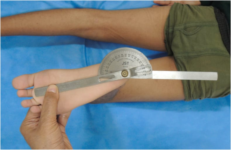 Clinical exam measuring the thigh-foot angle to assess tibial torsion in a child lying prone with knees bent