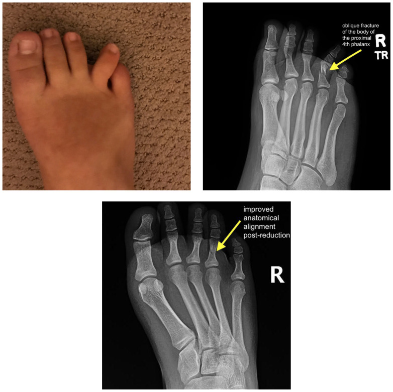 Three-panel clinical and radiographic series of a 4th toe fracture in a pediatric patient who stubbed her toe: top-left shows the clinical appearance of the foot with swelling and lateral deviation of the 4th toe; top-right is an AP X-ray with an arrow pointing to an oblique fracture through the body of the proximal 4th phalanx; bottom is the post-reduction X-ray showing improved anatomical alignment after manual reduction