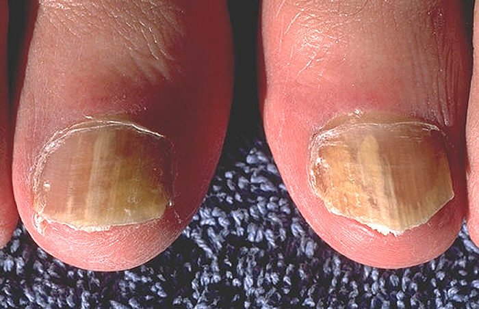 Onychomycosis caused by Trichophyton rubrum, affecting both great toes.
