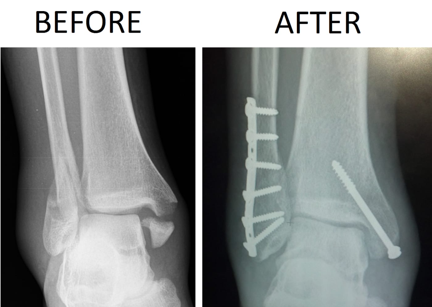 Trimalleolar ankle fracture before and after surgery — displaced injury reduced and stabilized with plate and screws (ORIF). Trimalleolar fractures involve the medial, lateral, and posterior malleoli and almost always require surgery.