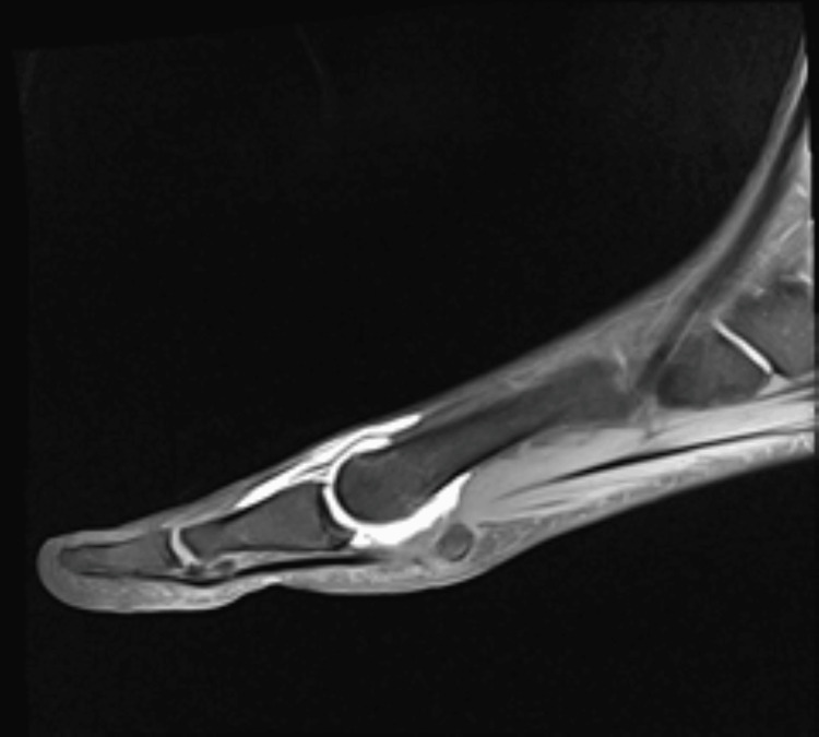 Turf toe — MRI demonstrating capsuloligamentous rupture of the plantar plate complex at the first MTP joint.