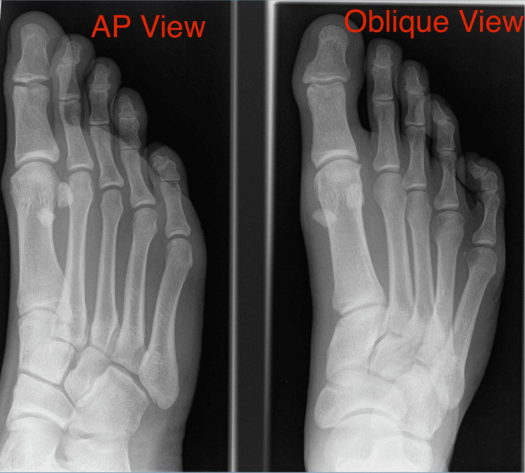 X-ray of the foot showing proximal migration of the sesamoid bones following severe turf toe injury
