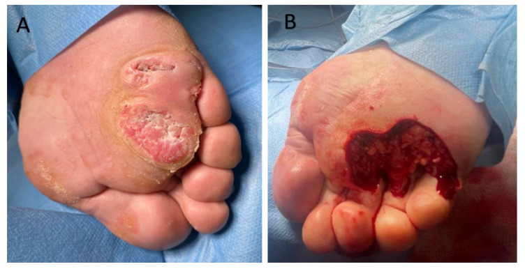 Clinical photograph of verrucous carcinoma — a low-grade variant of squamous cell carcinoma — on the anterior plantar foot, appearing as a thick warty exophytic lesion clearly demarcated from surrounding skin by a yellowish border