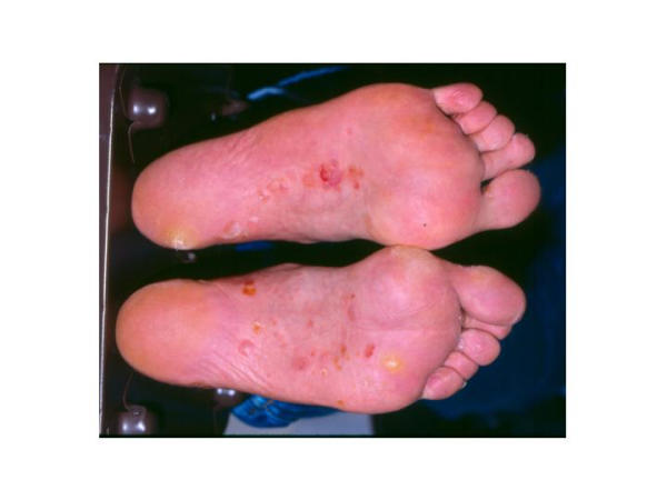 Vesiculobullous tinea pedis — fluid-filled blisters on the plantar surface of the foot