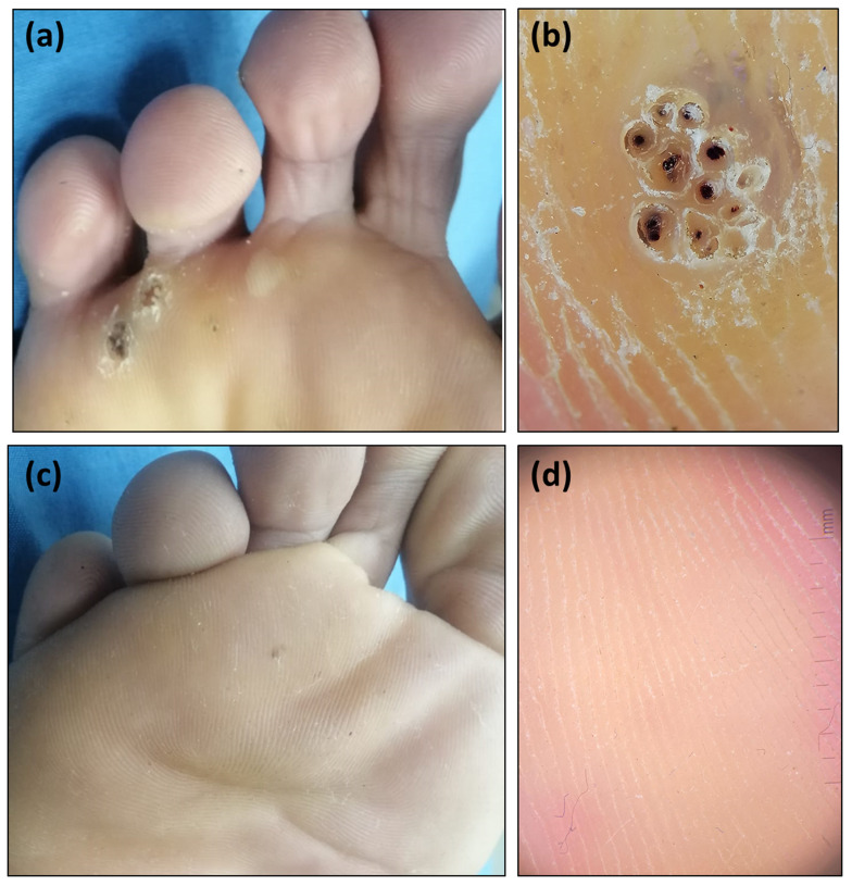 Four-panel clinical and dermoscopic photograph series of multiple plantar warts on the right foot of a 23-year-old male: (a) clinical photograph showing several rough, raised lesions on the sole, (b) dermoscopic close-up showing the classic frogspawn pattern and disruption of the normal skin lines (loss of dermatoglyphics), (c) the same foot showing complete clearance after treatment, (d) dermoscopic view confirming clearance