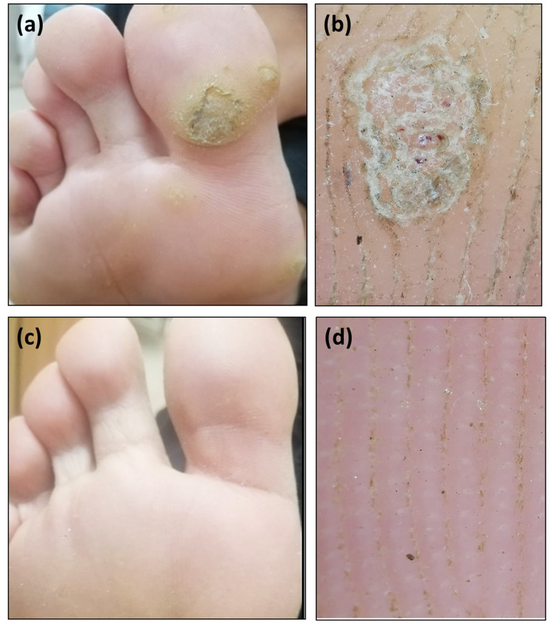 Four-panel clinical and dermoscopic photograph series of multiple plantar warts on the right foot of a 39-year-old female: (a) clinical photograph showing scattered raised lesions on the sole, (b) dermoscopic close-up showing scaly yellowish structureless areas with bleeding streaks and spots, (c) post-treatment clinical view showing clearance, (d) dermoscopic confirmation of clearance